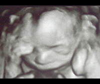 Pedro 22 semanas